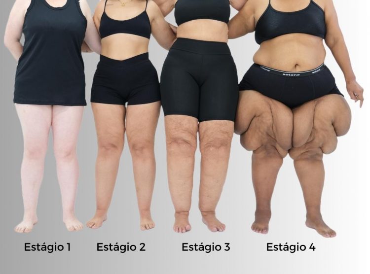 Graus de lipedema