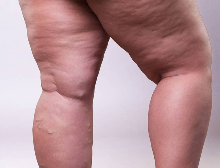 Lipedema: Listamos 12 principais dúvidas sobre o assunto