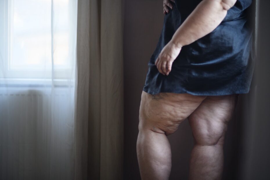 Tratamento do Lipedema